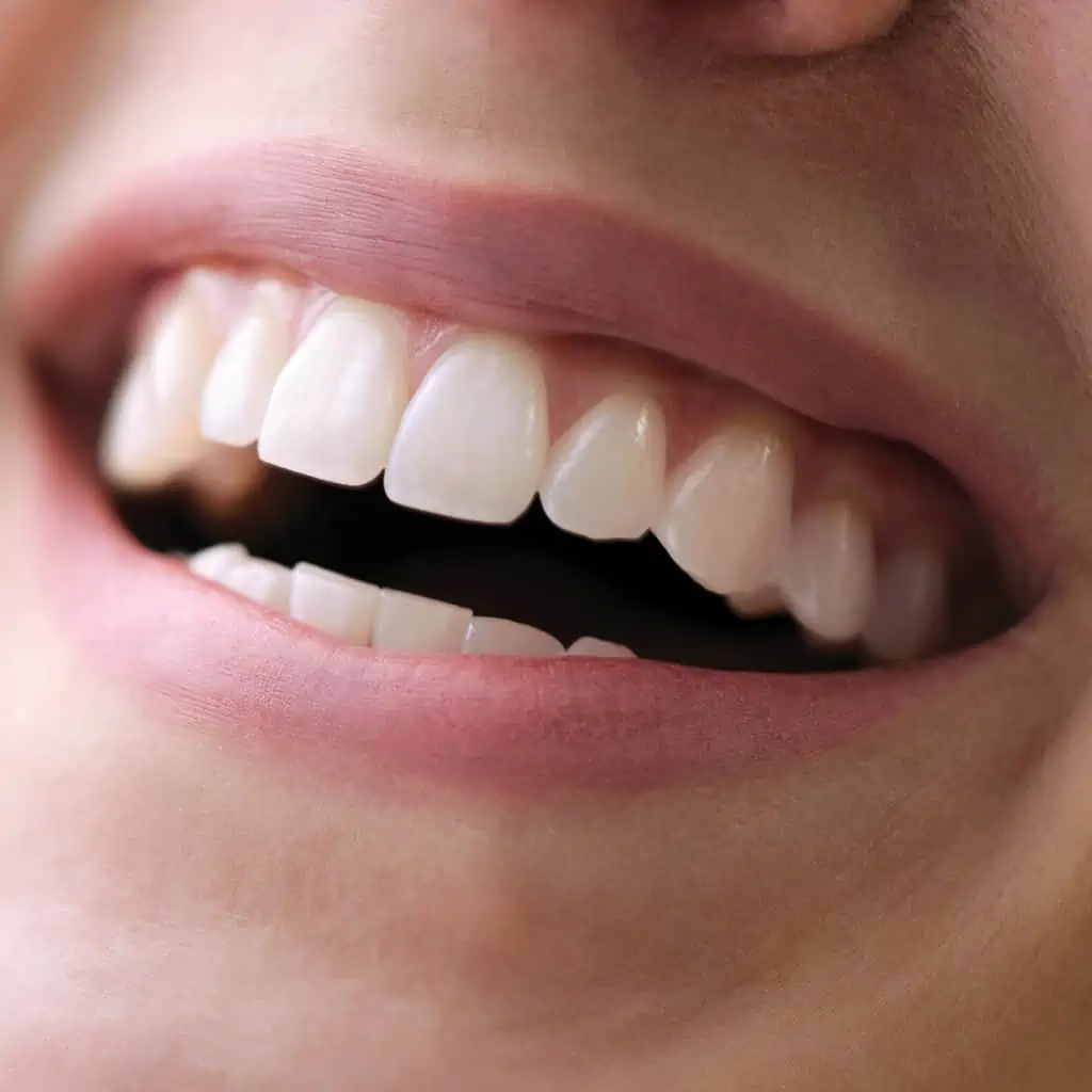 ونیر کامپوزیت دندان طبیعی