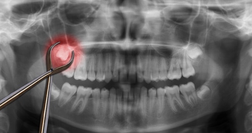جراحی دندان عقل با بیمه دندانپزشکی آتیه سازان حافظ