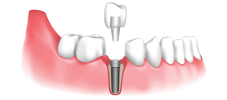 ایمپلنت دندان با بیمه دندانپزشکی آتیه سازان حافظ